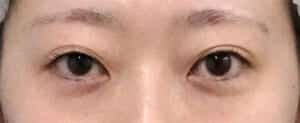 症例写真⑩手術前
