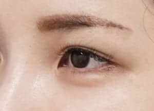 症例写真⑭左斜め2か月後