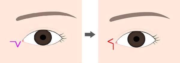 目頭切開Z形成（引っ張った状態）