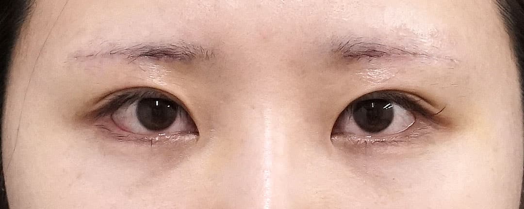 眉下切開　６日後のAfterの写真
