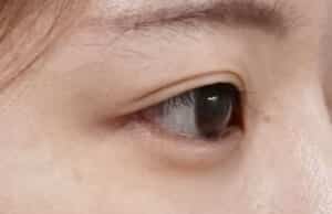 症例写真⑬右斜め3か月後