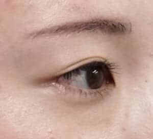 症例写真①右斜め6か月後