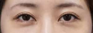 下眼瞼下制手術前
