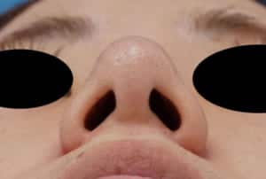 7 鼻翼縮小(flap外側) 3か月後 下から