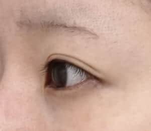 症例写真⑬左斜め術前