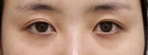 目頭切開(Z形成)、下眼瞼下制手術前
