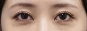 下眼瞼下制3か月後