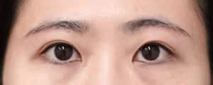 眉下切開、目の上脂肪取り　１ヶ月後