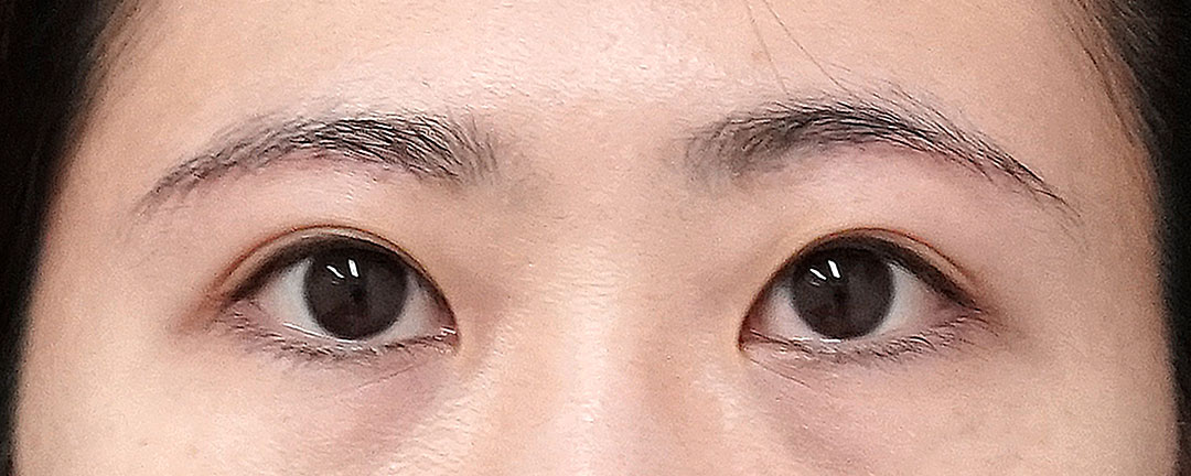 眉下切開、目の上脂肪取り　１ヶ月後のAfterの写真