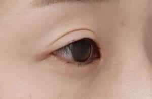 症例写真⑤右斜め6か月後
