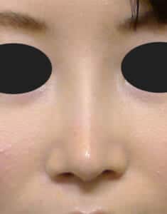 鼻中隔延長 正面3か月後