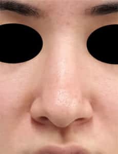 ④術前 正面
