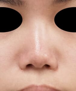 ぶた鼻と団子鼻 ミスコ正面 施術前