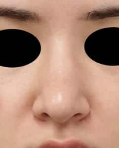 ④術後 正面