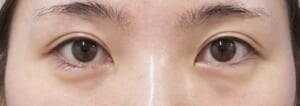 症例写真⑫手術前