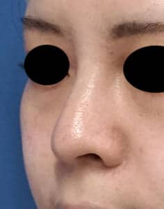 ミスコ 左斜め 術前