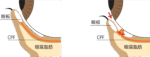 切らなたれ目縫縮の図