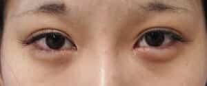 ①手術前