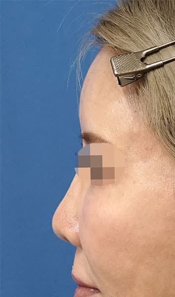 額ヒアルロン酸（ボリューマ）　２週間後　左側面のAfterの写真