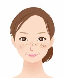 そばかす