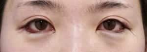 下眼瞼下制、目尻切開術直後