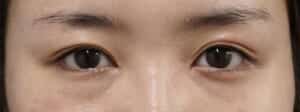 目頭切開(Z形成)、下眼瞼下制5か月後