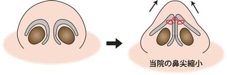 鼻尖縮小のイラスト