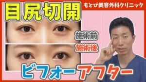 目尻切開のビフォーアフター