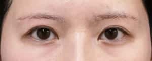 他院眉下切開修正手術　６ヶ月後