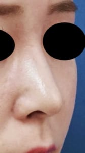 ①術後 右ナナメ