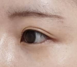 症例写真⑬左斜め3か月後