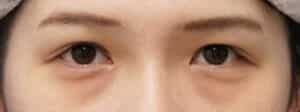 症例写真⑥3か月後