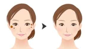 シミ改善