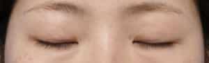 症例②閉眼