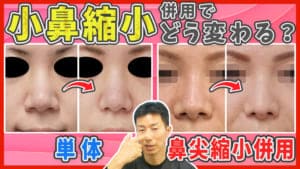 【鼻整形】理想の小鼻になるには、小鼻縮小と鼻尖縮小は併用すべきなのかを解説のサムネイル