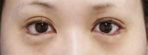 下眼瞼下制手術直後