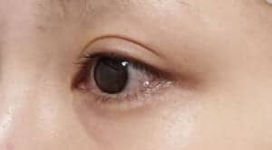 症例写真⑪左斜め6か月後