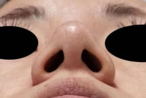7 鼻翼縮小(flap外側) 手術前 下から