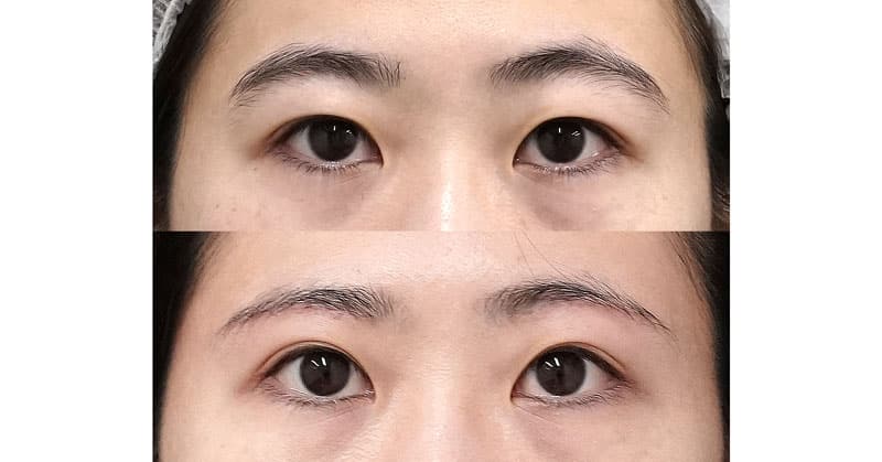 上瞼をすっきりさせたい！｜眉下切開、目の上脂肪取り　１ヶ月後