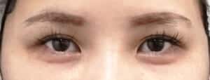 症例写真⑭手術前