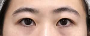 眉下切開、目の上脂肪取り　手術前
