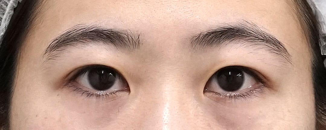 眉下切開、目の上脂肪取り　１ヶ月後のBefore写真