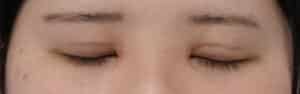 全切開症例③閉眼