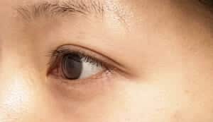 症例写真④左斜め手術前