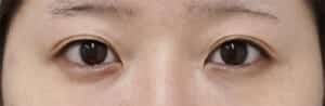 ④手術前