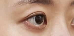 症例写真③右斜め術前