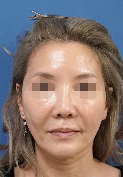額ヒアルロン酸(ボリューマ) 2週間後 正面のBefore写真