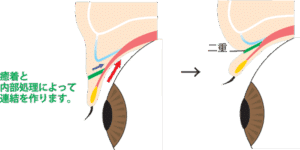 二重全切開の構造（断面図）