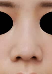 鼻尖縮小+軟骨移植 正面 3か月後