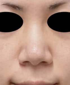 7 鼻翼縮小(flap外側) 手術前 正面